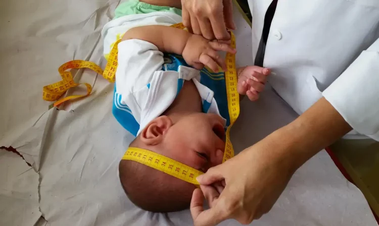 Bebê com microcefalia